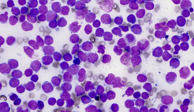 Exploring checkpoint inhibitors in Acute Lymphoblastic Leukemia