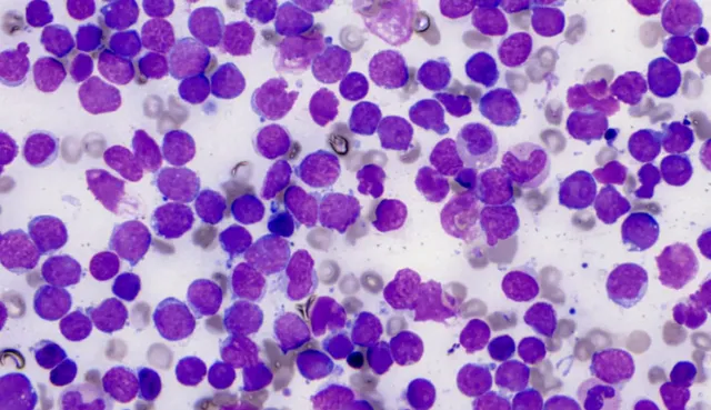 Exploring checkpoint inhibitors in Acute Lymphoblastic Leukemia