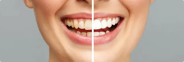 Teeth whitening tools and its effects on teeth and gum health